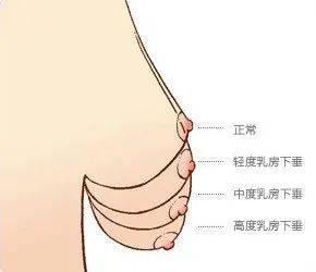 乳房产后下垂怎么办