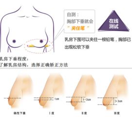 乳房产后下垂怎么办